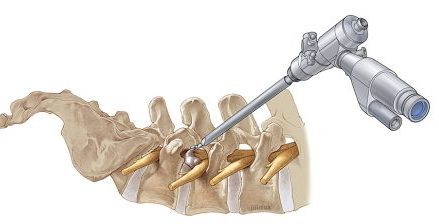 Endoscopic spine surgery