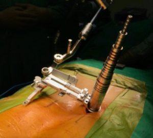 Minimally-Invasive-Spine-Surgery-retractor-e1591091624890-300x271