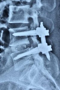 Spine-Instrumentation-Fusion-Dr.-Amit-Sharma-Minimally-Invasive-Spine-Surgeon-Mumbai-oohnq8am5c6vnetbrqmny8t0sf5zqx7fkvcsqoh08g