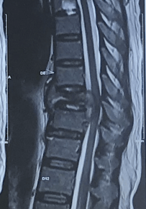 Spinal tuberculosis MRI