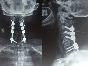 Posterior cervical spine surgery