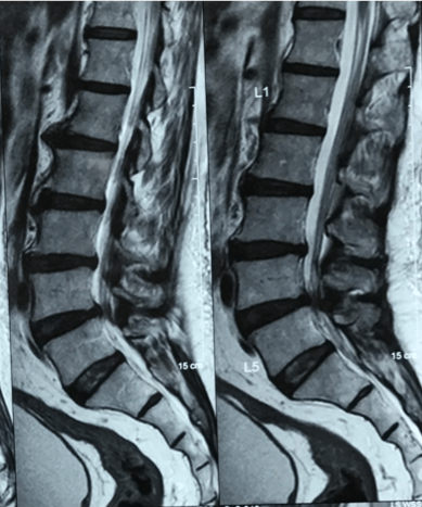 Spine MRI
