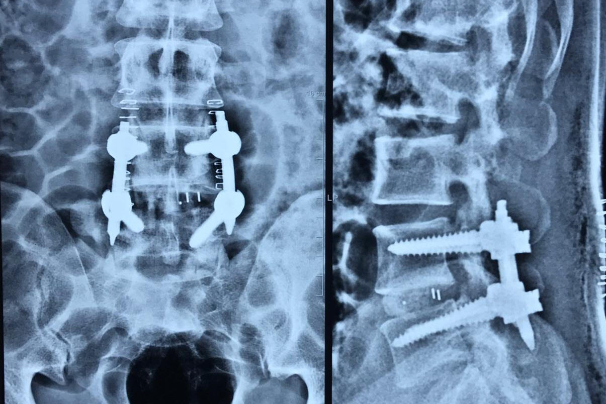 Do You Need Spine Instrumentation?