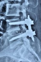 Spine-Instrumentation-Fusion-Dr.-Amit-Sharma-Minimally-Invasive-Spine-Surgeon-Mumbai-oohnq8am5c6vnetbrqmny8t0sf5zqx7fkvcsqoh08g